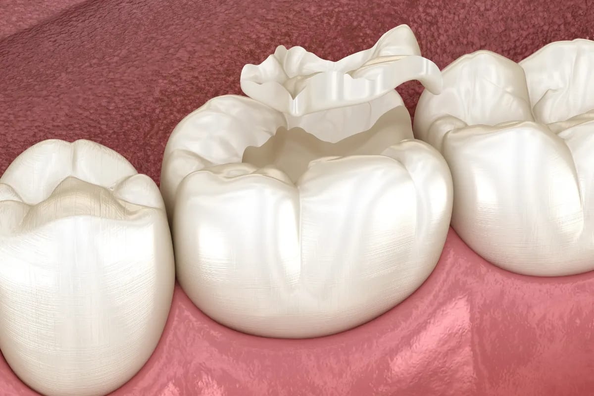 Sealants and Fillings: Protecting Your Teeth in Plano, Texas, Plano, TX Illustration of Tooth Decay