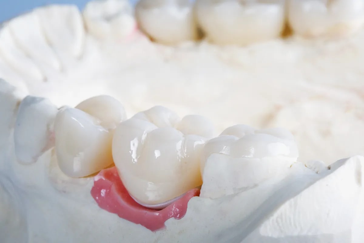 Crowns in Plano: Restoring Your Smile on W Spring Creek Pkwy, Plano, TX Icon Smiles Dental office