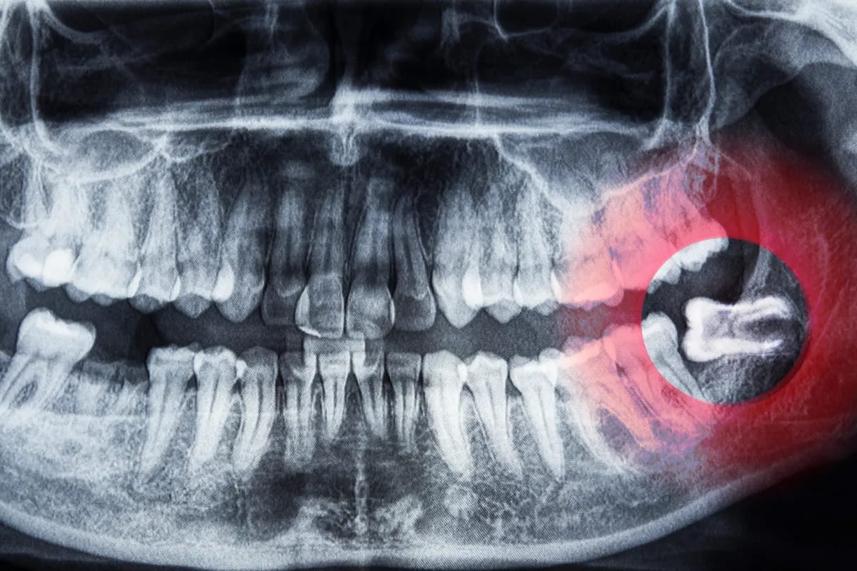 Wisdom Teeth Extraction: Finding Relief in Plano, TX, Plano, TX Image of dental tools used during an extraction procedure.