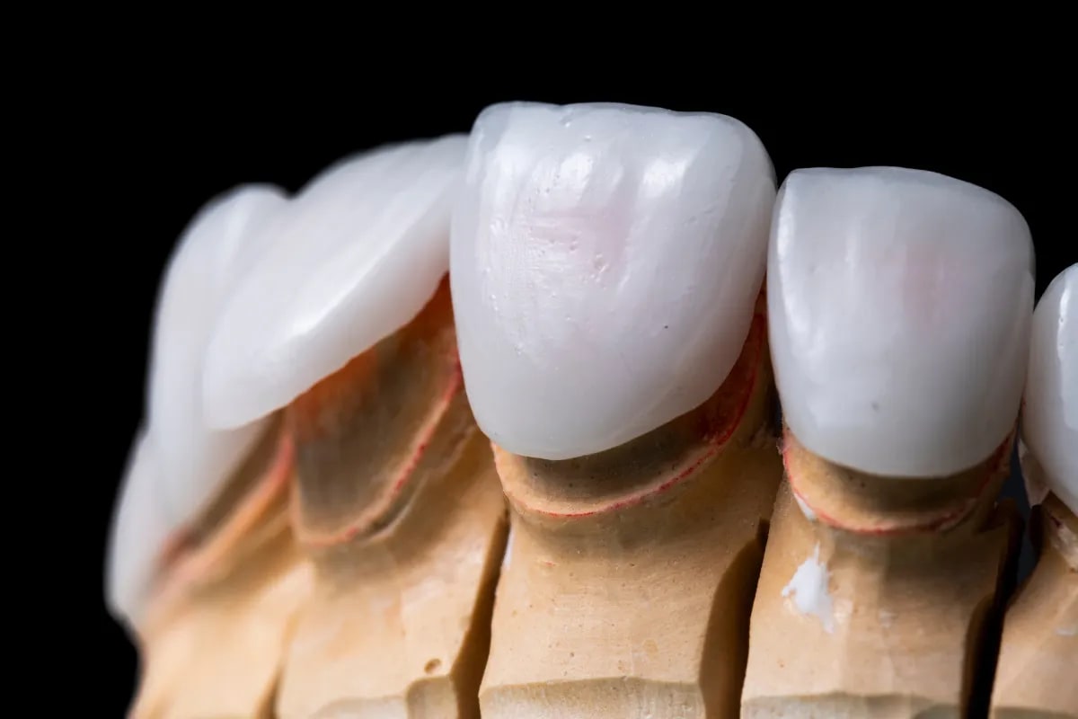 Veneers in West Plano: Achieving Your Dream Smile Near Willow Bend, Plano, TX Veneers before and after