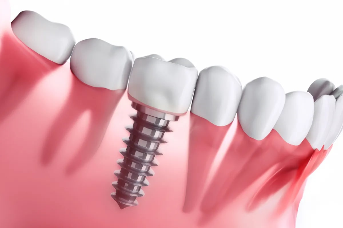Single Tooth Implant Cost: Plano's Comprehensive Breakdown, Plano, TX Comparison of dental implant and bridge