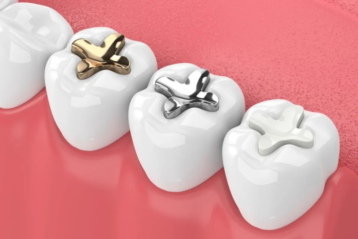 Dental Sealants for Kids in Plano: Protecting Against Cavities, Plano, TX Child's teeth with sealants
