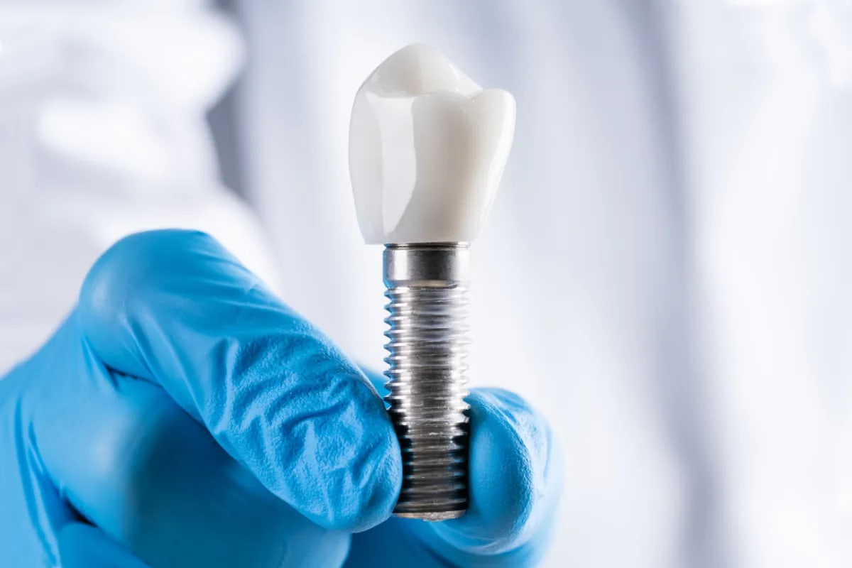 The Long-Term Value of Single Implants in Plano, Texas, Plano, TX Dental implant procedure