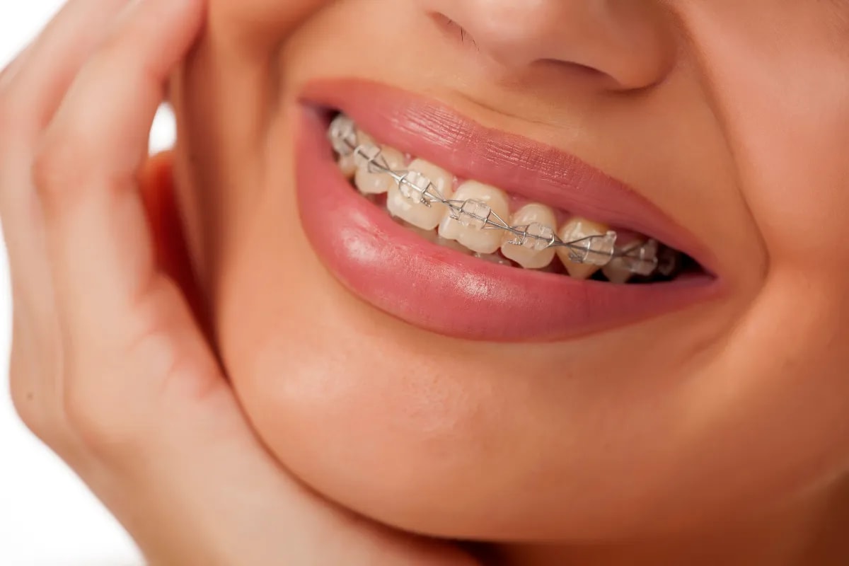 Invisalign vs. Traditional Braces: A Plano Guide, Plano, TX Factors to consider