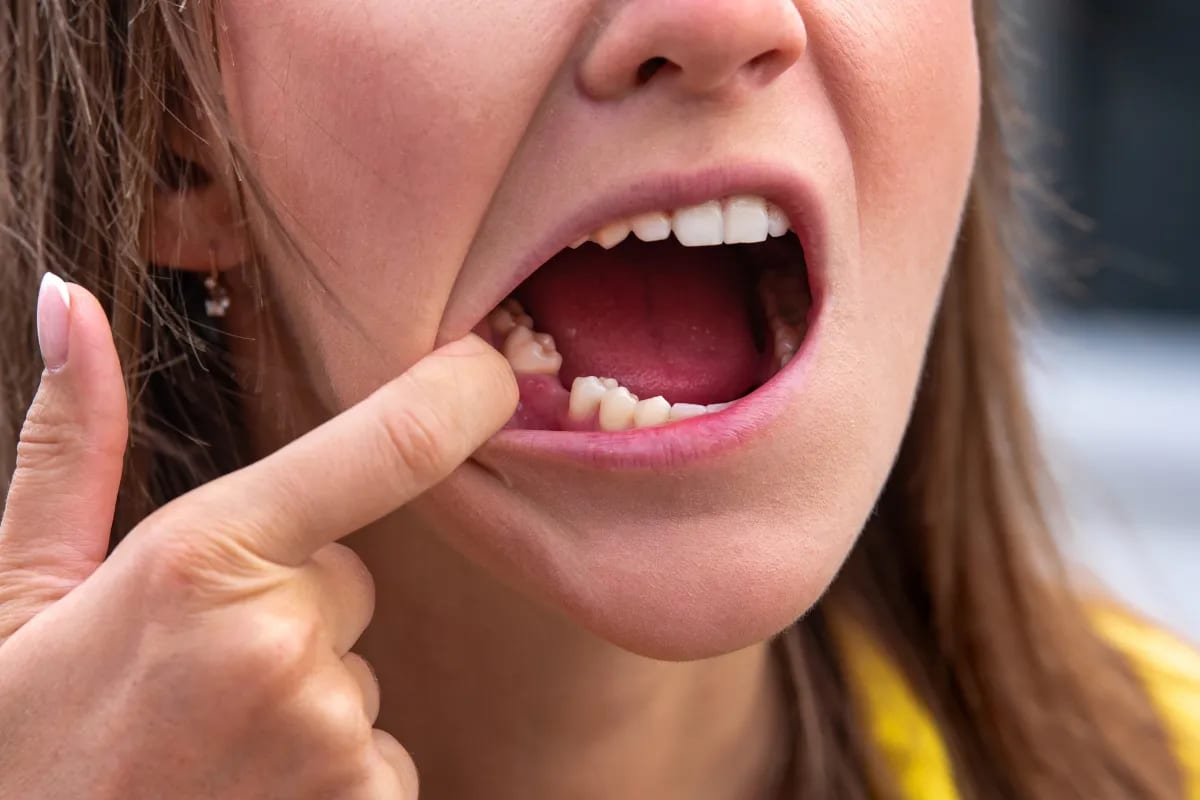 Bridge Missing Teeth in Plano: Options and Costs Near 75023, Plano, TX Dental bridge illustration