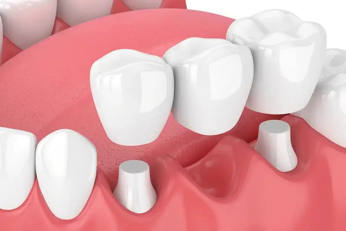 Addressing Missing Teeth with Dental Bridges in Plano, Plano, TX Smiling woman with a restored smile thanks to dental bridge.