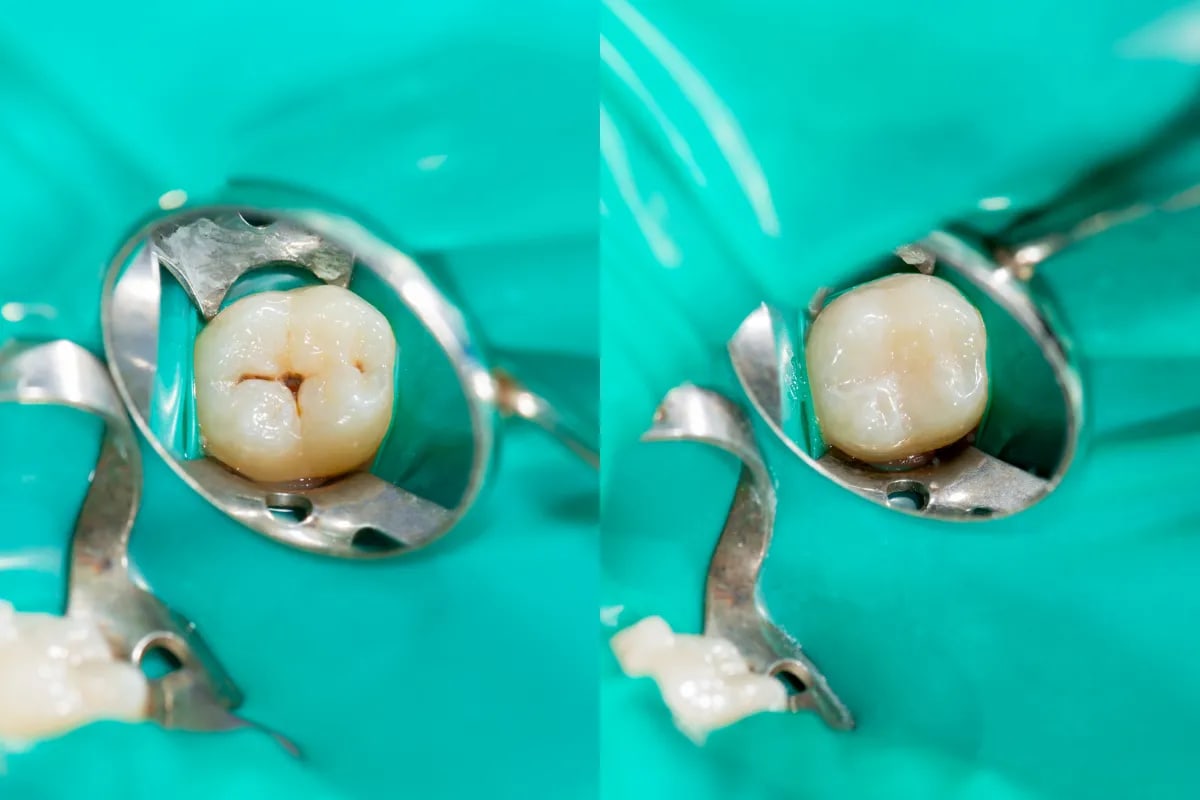 Dental Sealants: Preventing Cavities in Plano Children, Plano, TX Comparison of sealants and fillings on a tooth model