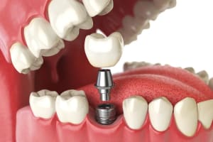 Dental Blog, Plano, TX Dental Blog, Plano, TX