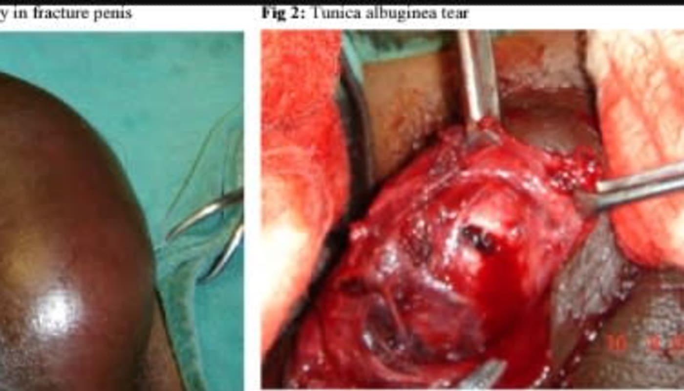 Penile Fracture: An Overlooked Medical Emergency