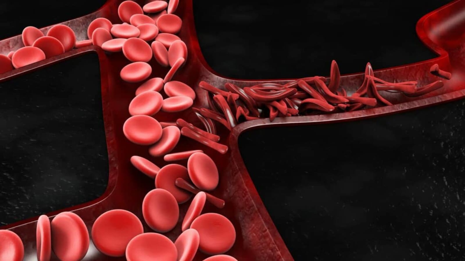Sickle Cell Breakthrough: Nigeria Gets Bone Marrow Transplant Cure