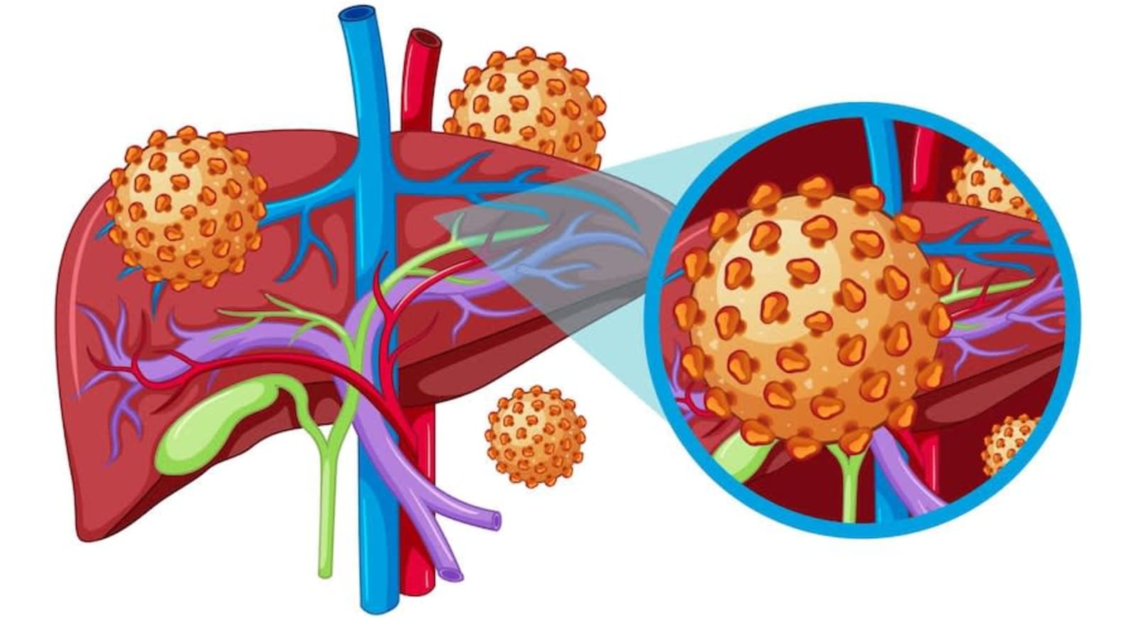 Hepatitis Explained: Why Hepatitis B Is a Major Health Concern in Nigeria