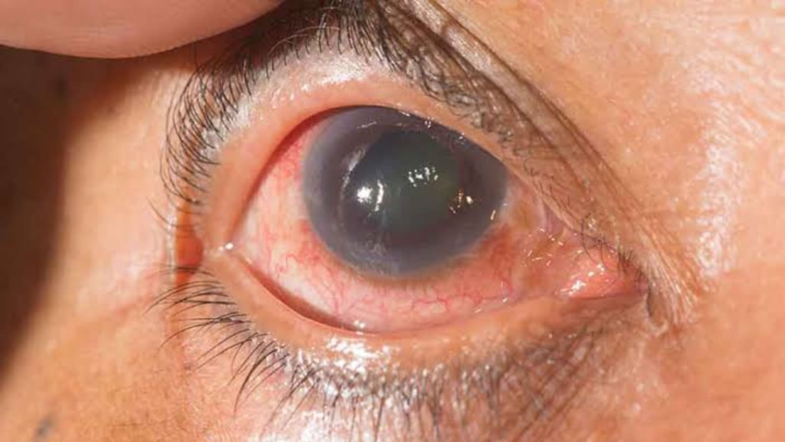 Glaucoma: The Silent Thief of Sight You Shouldn’t Ignore