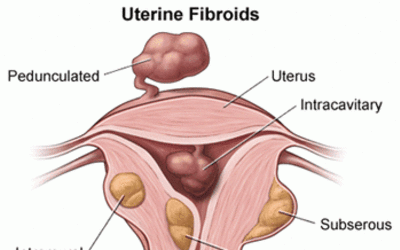 Understanding Uterine Fibroids: Symptoms, Causes, Diagnosis, Treatment and Prevention