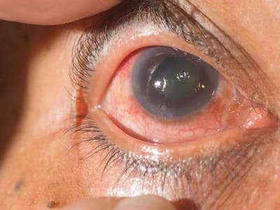 Glaucoma: The Silent Thief of Sight You Shouldn’t Ignore