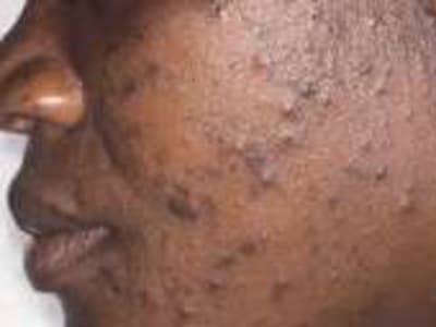 What Causes Pimples on the Face? Understanding Acne in Simple Terms
