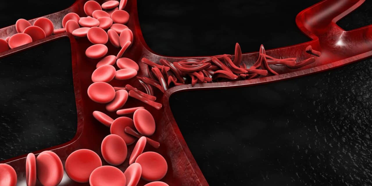 Sickle Cell Breakthrough: Nigeria Gets Bone Marrow Transplant Cure
