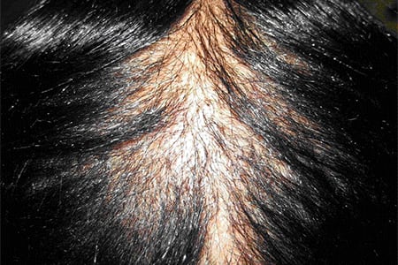 Don't Ignore the Pain: Spotting CCCA (Central Centrifugal Cicatricial Alopecia) Early