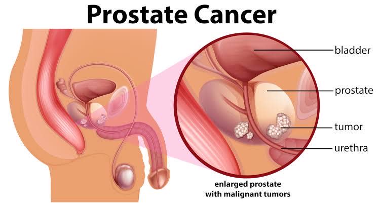 Prostate Cancer: What Every Man Should Know