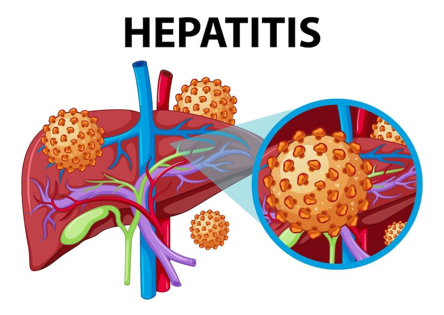 Hepatitis Explained: Why Hepatitis B Is a Major Health Concern in Nigeria