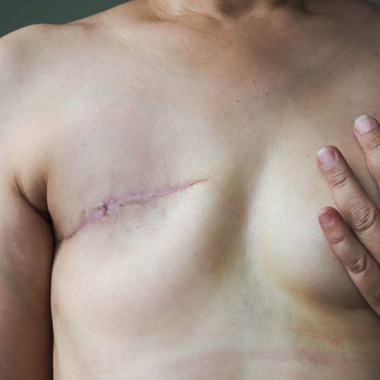 Mastectomy:The surgery that saves lives but Changes everything