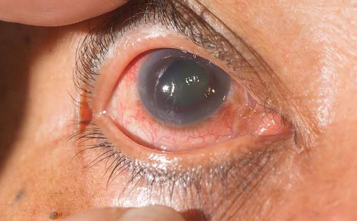 Glaucoma: The Silent Thief of Sight You Shouldn’t Ignore