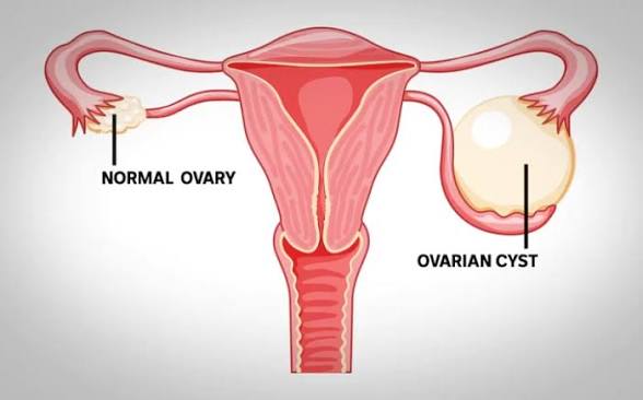 Ovarian Cysts: What Every Woman Should Know