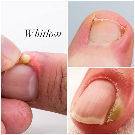 Whitlow: The Painful Finger Infection You Shouldn’t Ignore
