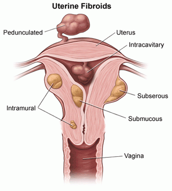 Understanding Uterine Fibroids: Symptoms, Causes, Diagnosis, Treatment and Prevention