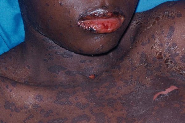When Medicine Turns Dangerous: Understanding Stevens-Johnson Syndrome