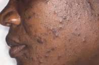 What Causes Pimples on the Face? Understanding Acne in Simple Terms
