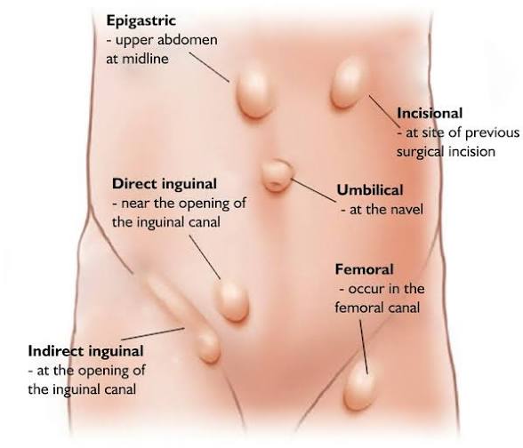 Hernia: A Complete Medical Guide to Causes, Types, Symptoms, Diagnosis, and Treatment