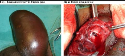 Penile Fracture: An Overlooked Medical Emergency