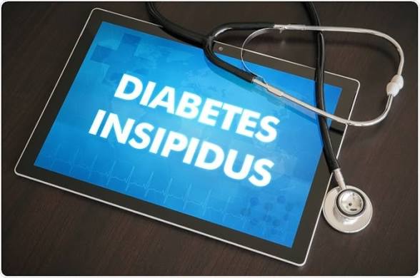 Diabetes Insipidus: Understanding Its Causes, Types, Symptoms, Diagnosis, Treatment, and Complications