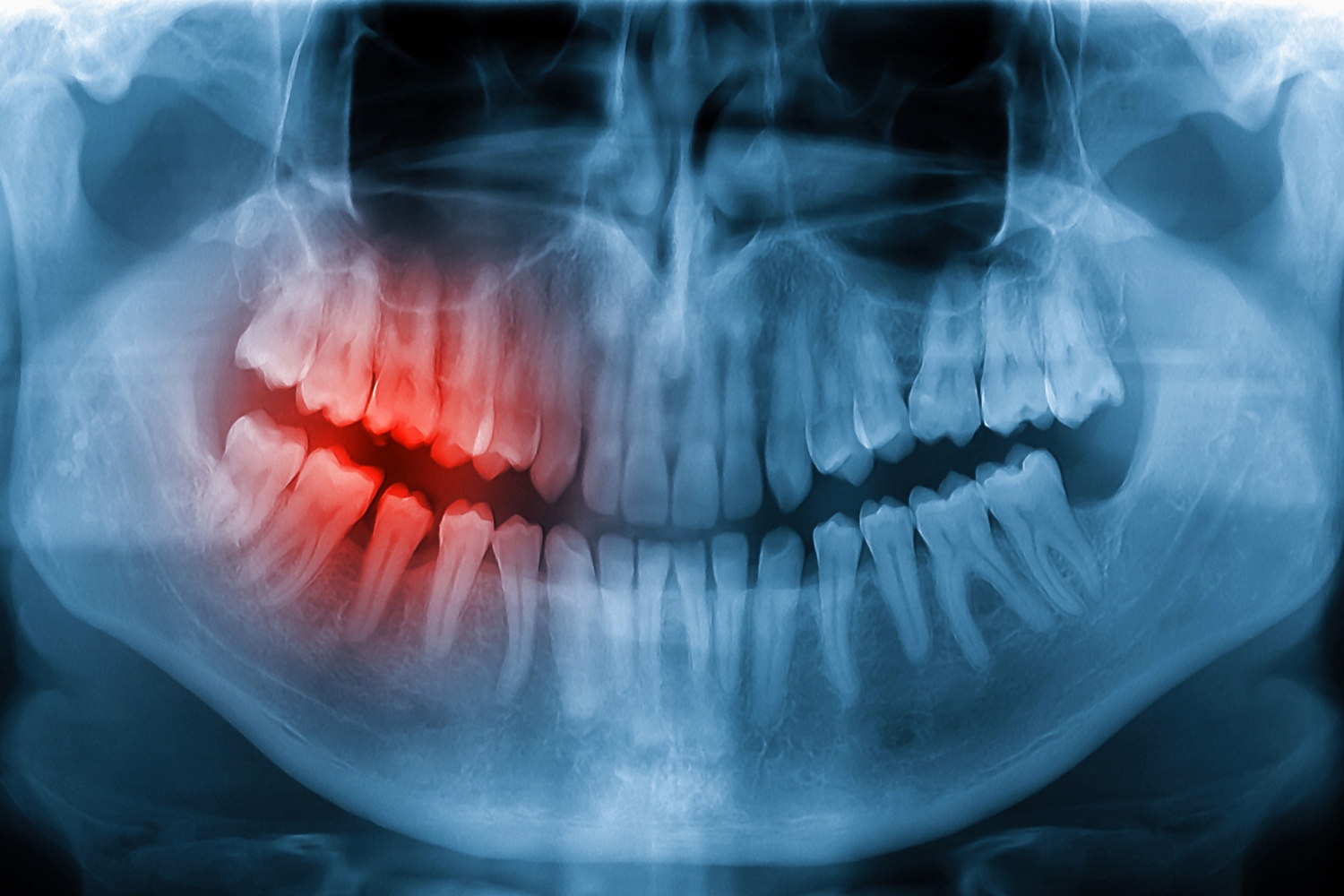 Diagnóstico endodoncia