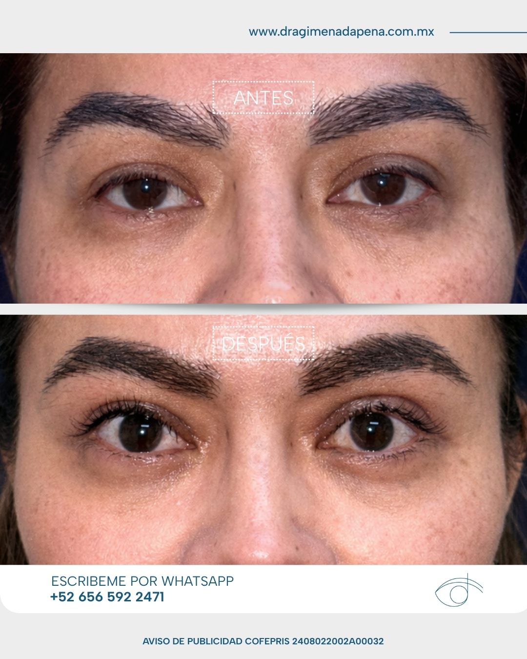Caso Blefaroplastia superior cirug%C3%ADa de ptosis reposici%C3%B3n de gl%C3%A1ndula lagrimal 1 m6ktfi