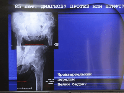 Сургутские травматологи в лечении переломов бедра используют современные технологии