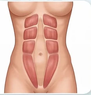 Ilustración de diástasis abdominal abierta, con separación a lo largo de toda la línea alba