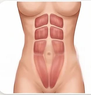 Ilustración de diástasis abdominal umbilical, con separación a la altura del ombligo