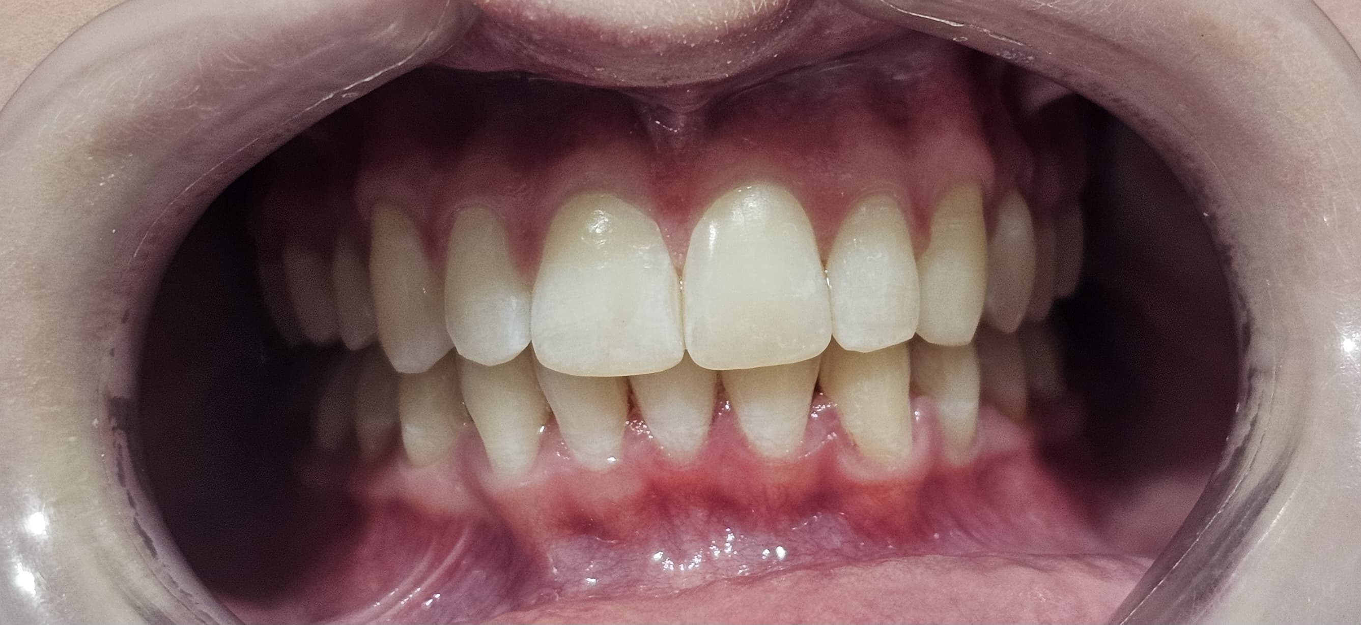 After Invisalign Treatment
