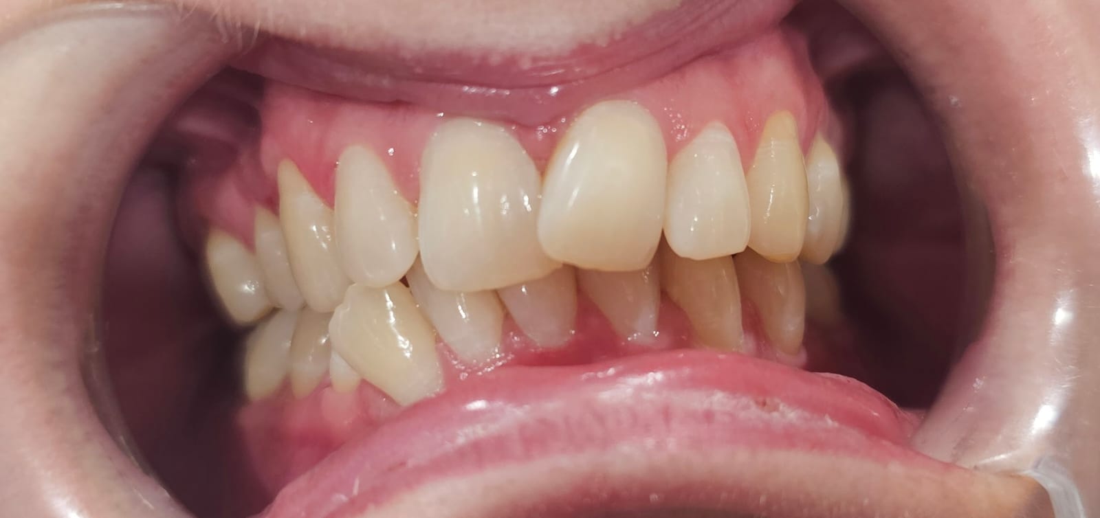 Before Invisalign Treatment