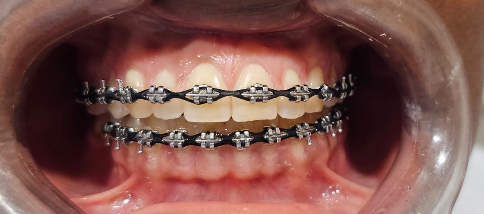 After Braces Treatment