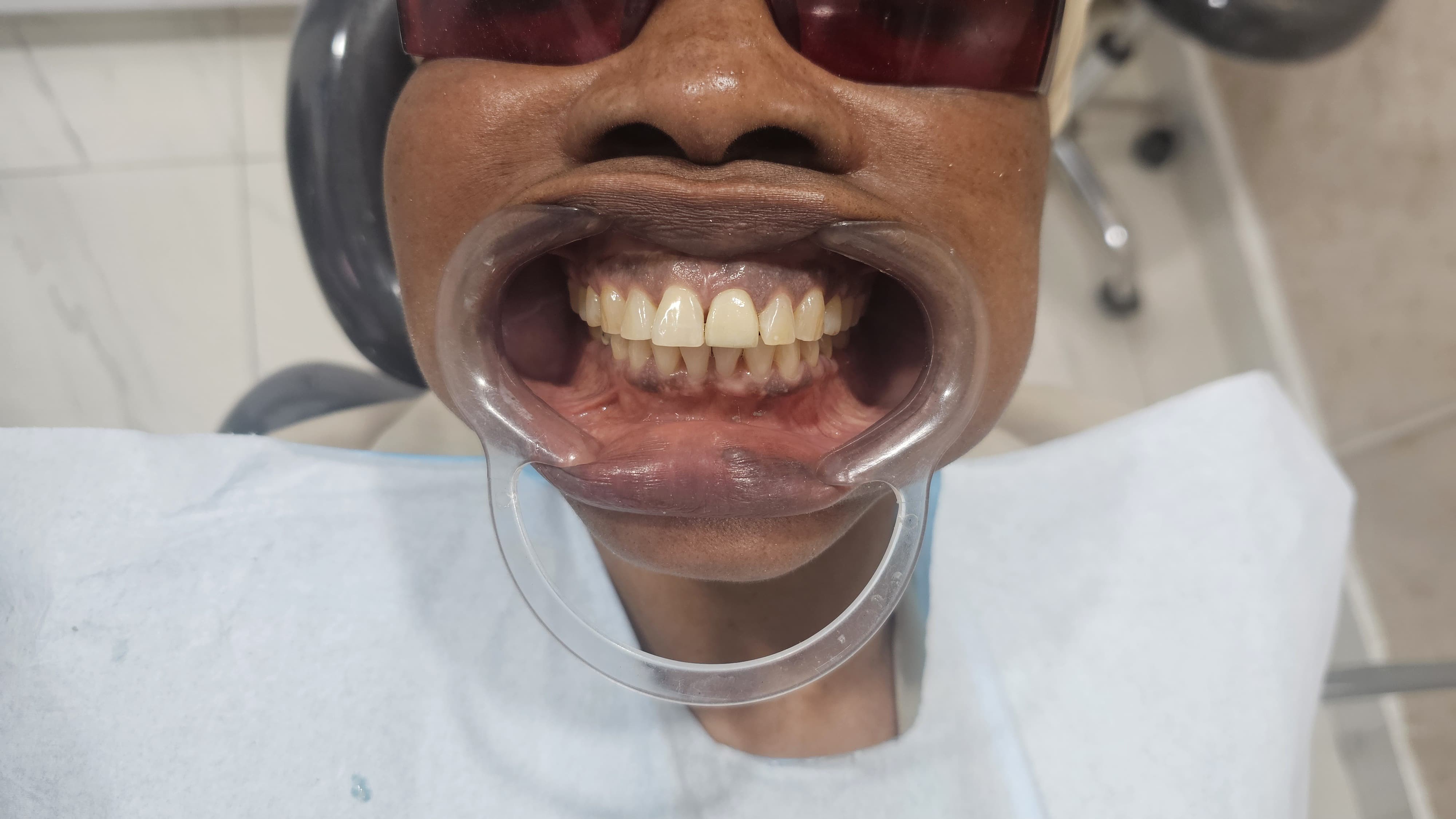 After Dental Crowns