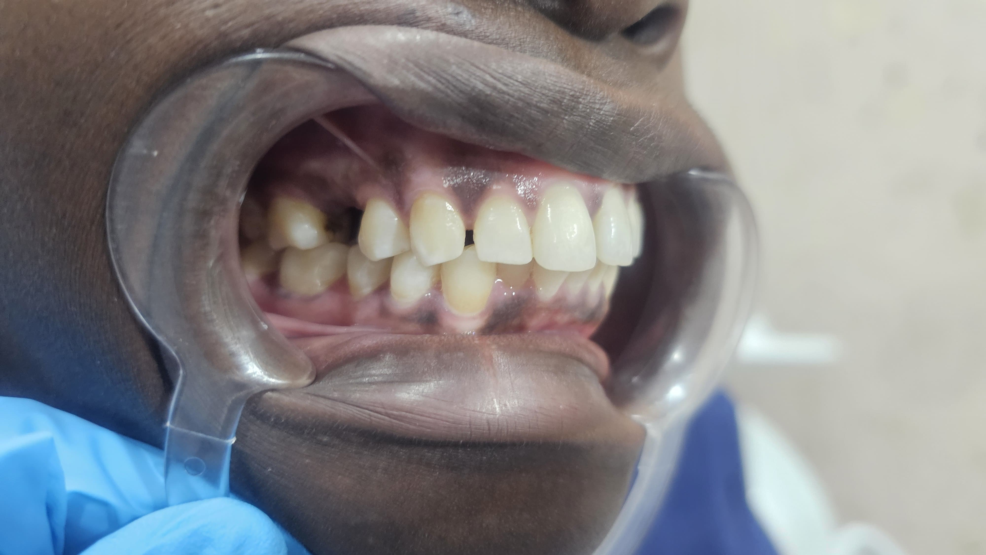 Before Dental Implants
