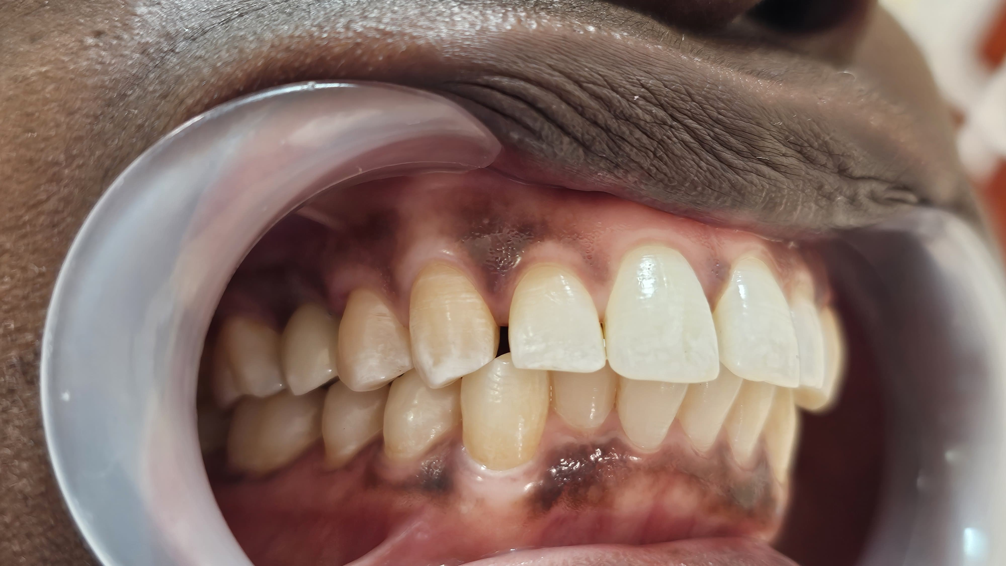 After Dental Implants