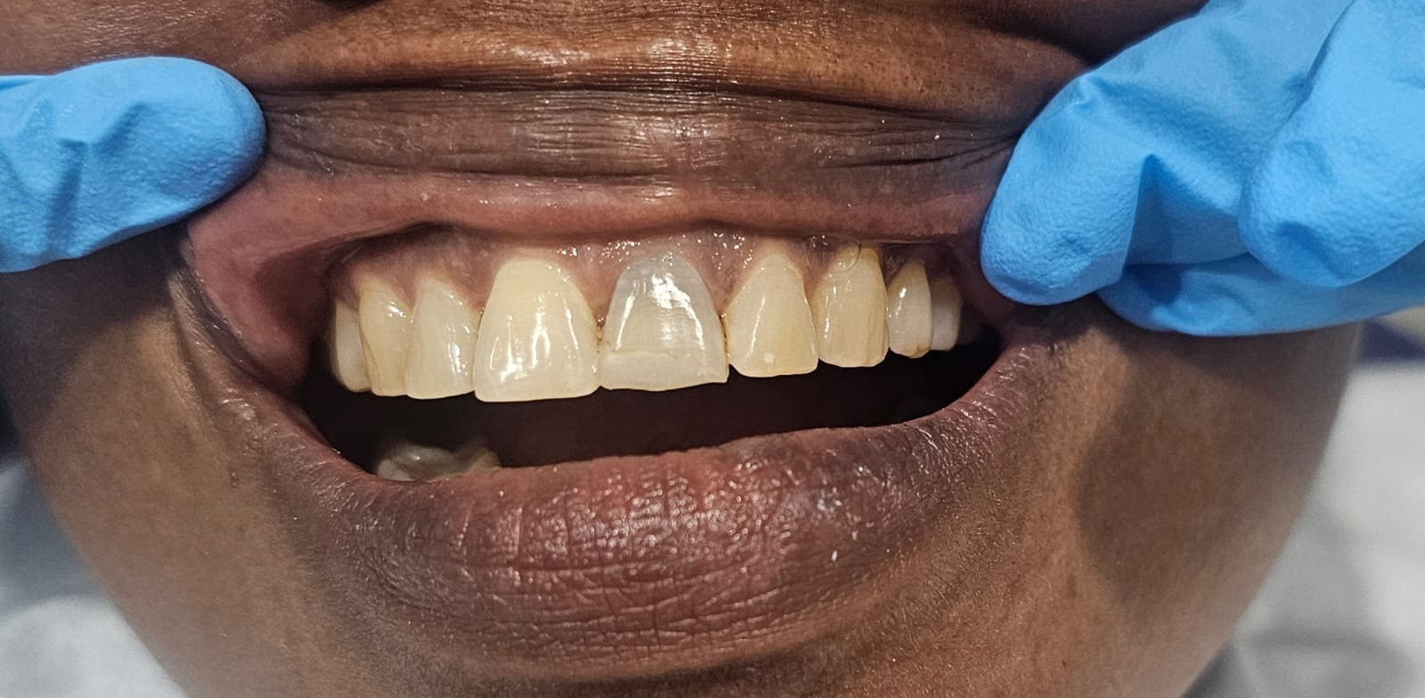Before Dental Crowns