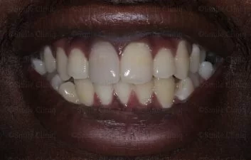 Before Teeth Whitening