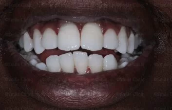 After Teeth Whitening