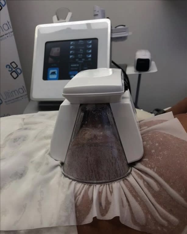 3D Lipo Cavitation 
