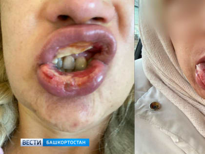 «У меня химический ожог рта»: в Башкирии врач перепутал раствор и влил в рот пациентке нашатырь