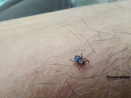 Жители Башкирии продолжают обращаться за медпомощью по случаю присасывания клещей